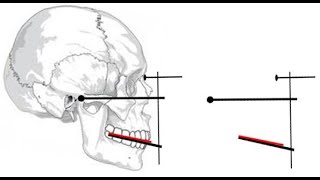 Orientation jaw relation made easy Why we record orientation jaw relationWhat is facebow [upl. by Lyrred]