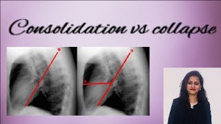 Chest X ray  How to differentiate consolidation from collapse [upl. by Clapp]