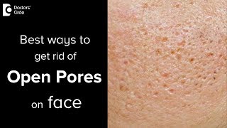 What are open pores and treatment options for that  Dr Vignesh Raj [upl. by Mohr]