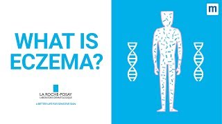 What Is Eczema  La RochePosay [upl. by Analem244]