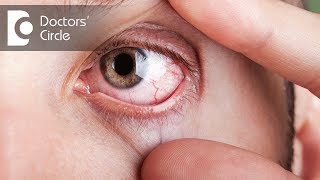 What causes visible red fine lines in eyes  Dr Elankumaran P [upl. by Ahsilak779]