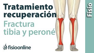 FRACTURA de TIBIA y PERONÉ Rehabilitación ejercicios y tiempo de recuperación [upl. by Durrell]