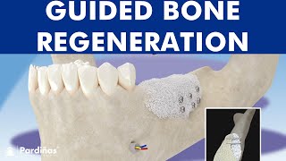 Guided bone regeneration  Bone graft © [upl. by Ingeberg]