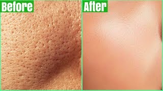 How To Get Rid Of LARGE PORES PERMANENTLY 100 Works Shrink amp Get Clear Glass Skin Naturally [upl. by Rotsen]