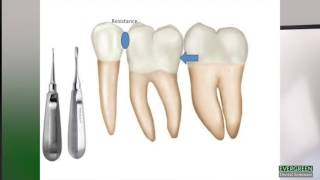 How to make molar extractions easier [upl. by Hildy528]