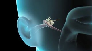 766  Severely Retracted Eardrum Ear Wax Removal [upl. by Yentiw848]