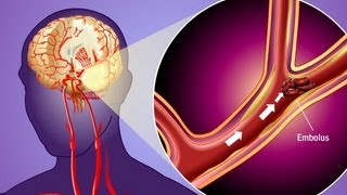 Stroke Prevention amp Transient Ischemic Attack TIA [upl. by Rizas444]