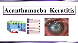 Acanthamoeba Keratitis [upl. by Ariew825]