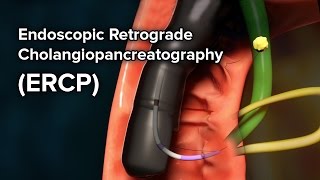 Percutaneous antegrade jj stent insertion [upl. by Sudnac]