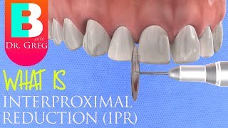 Interproximal Reduction IPR Stripping of Teeth for Braces or Invisalign [upl. by Ymiaj]