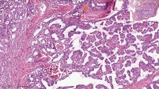 Papillary Thyroid Carcinoma  Histopathology [upl. by Gunther689]