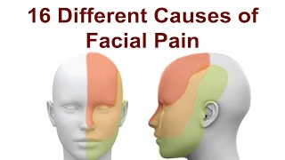 16 Causes of Facial Pain and Treatment Strategies [upl. by Antonietta]