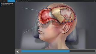 Traumatic Brain Injury  Brain Surgery Animation [upl. by Jana]