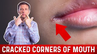 What Causes Cracked Corners of Mouth amp How to Get Rid of Angular Cheilitis – Dr Berg [upl. by Chenee]