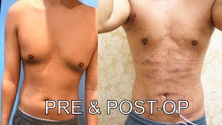 GYNECOMASTIA Surgery 48 hrs PostOP Results BEFORE AND AFTER 🔥  Dr Lebowitz [upl. by Graces]