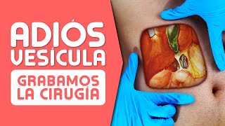 LA VESÍCULA ¿Cuándo es Mejor OPERAR Síntomas Cálculos Pólipos y Cáncer [upl. by Enninaej]