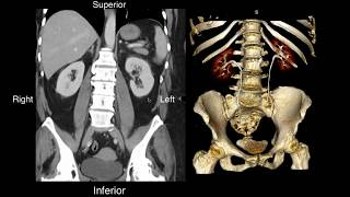 Normal Renal Anatomy [upl. by Niboc16]