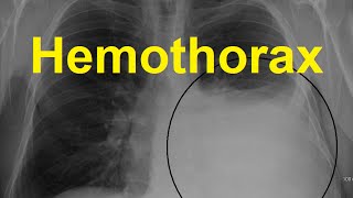 Hemothorax Symptoms Causes and Treatment [upl. by Dahl421]