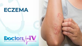 Eczema Symptoms Causes and Treatment  Doctors on TV [upl. by Ehtnax98]