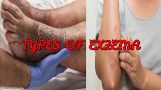 7 TYPES OF ECZEMA YOU NEED TO KNOW [upl. by Ynots]