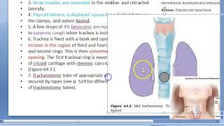 ENT Tracheostomy technique steps [upl. by Airotnahs]