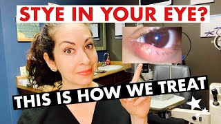 STYES  What are they and how are they treated  The Eye Surgeon [upl. by Adnorahs]