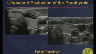 Ultrasound Evaluation of the Parathyroid [upl. by Cleo]