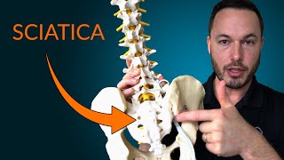 Understanding Sciatica Everything you need to know about the causes and treatment of sciatica [upl. by Comyns644]