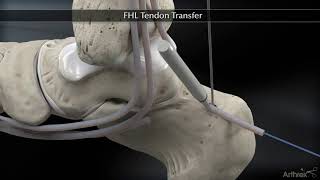 Flexor Hallucis Longus FHL Tendon Transfer [upl. by Yemerej472]