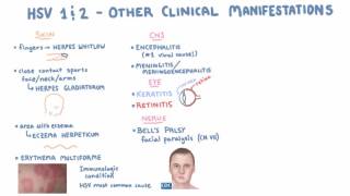 HSV  Clinical Presentation  Part 2 [upl. by Moyra]