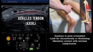 Ultrasound Tutorial MSK Series Achilles Tendon  Radiology Nation [upl. by Talanta]