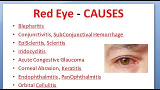 Ophthalmology 167 Acute Red Eye Differential Diagnosis causes Conjunctivitis Uveitis Glaucoma [upl. by Llenel280]