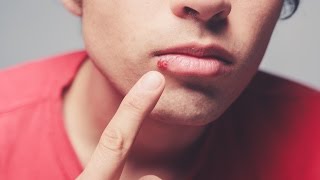 Dermatologist explains causes of cold sores [upl. by Decrem]