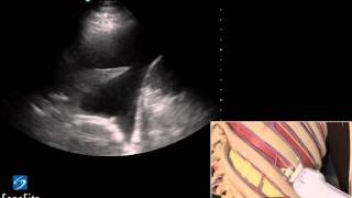 3D Lehrvideo Ultraschallgestütze Thoracentesis Untersuchung  SonoSite Ultraschall [upl. by Revorg]