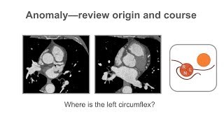 Tracheostomy PAM Valve Placement and Removal [upl. by Piwowar]