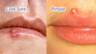 Pimple vs Cold Sore The Differences Identification and Treatment [upl. by Ikila]