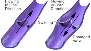 What are venous stasis leg ulcers Complications of Venous Insufficiency  Texas Endovascular [upl. by Sari235]