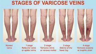 Stages of Varicose Veins [upl. by Egni744]