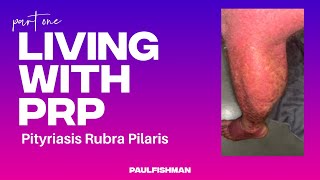 Living with PRP pityriasis rubra pilaris [upl. by Bamby]