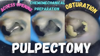 Pulpectomy  access opening  chemomechanical preparation  obturation  pulpectomy procedure 84 [upl. by Olracnaig]