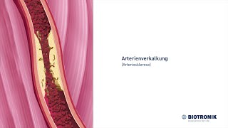 Arterienverkalkung Arteriosklerose und Angiografie [upl. by Lainad]