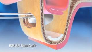 How Bone Graft Works 2 [upl. by Zeb]