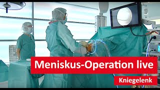 Kniegelenk MeniskusOperation live [upl. by Heber]