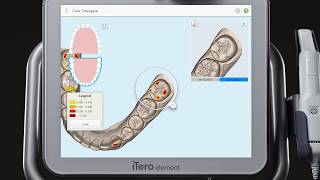 iTero® Scanner Tutorial TimeLapse Technology [upl. by Erving417]