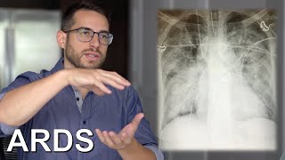 Acute Respiratory Distress Syndrome ARDS [upl. by Ayatahs]