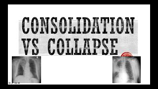 How to differentiate consolidation from collapse in a Chest Xray [upl. by Gad]