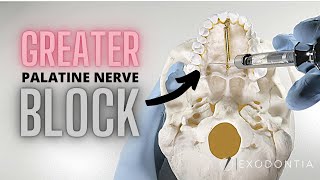 GREATER PALATINE NERVE BLOCK  OnlineExodontiacom [upl. by Bravin254]