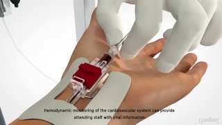 MEDBAR  Arterial Cannula [upl. by Udelle126]