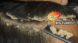 Itchy Scalp Dandruff Removal Satisfying 560 [upl. by Efinnej]