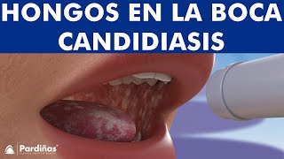 CANDIDIASIS oral y BOQUERAS  Cómo CURAR los hongos de la boca © [upl. by Remos]